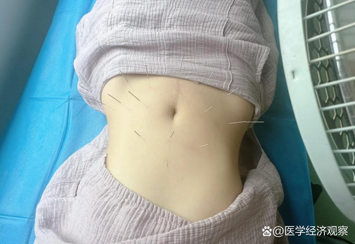 产后多久可以针灸(产后多久可以针灸减肥瘦身)