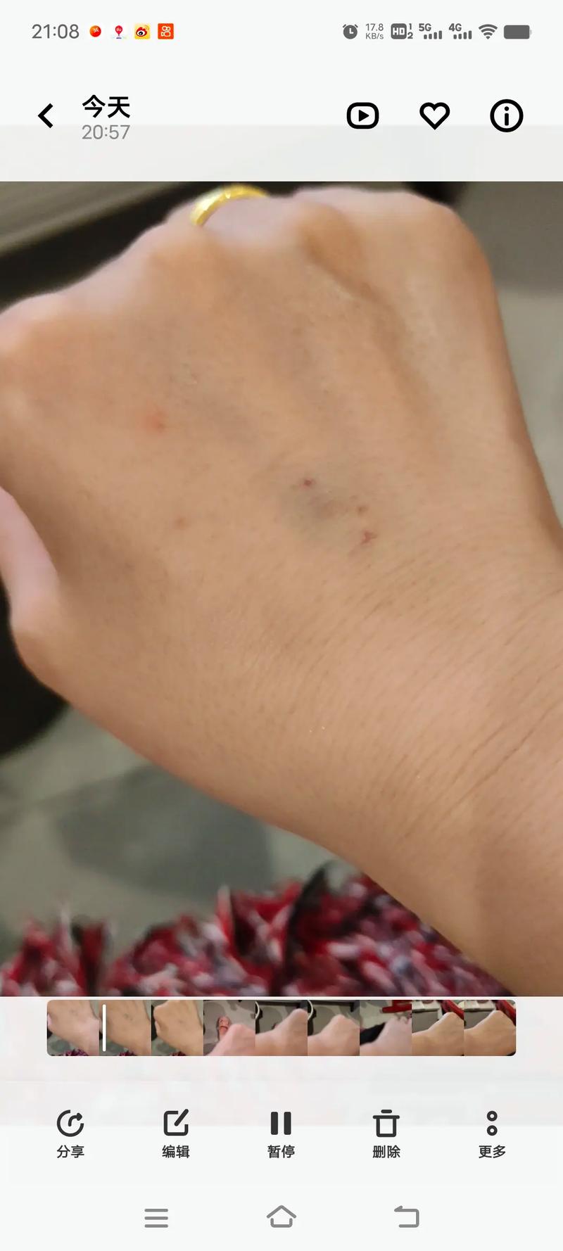 输液为什么会肿(输液为什么会肿脚)