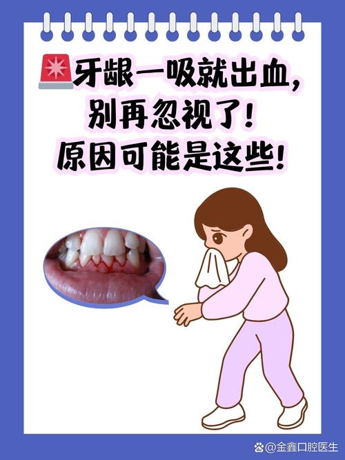 洗牙为什么会出血(洗牙为什么会出血要紧吗)-第1张图片-天汇百科网 洗牙为什么会出血(洗牙为什么会出血要紧吗)-第1张图片-天汇百科网