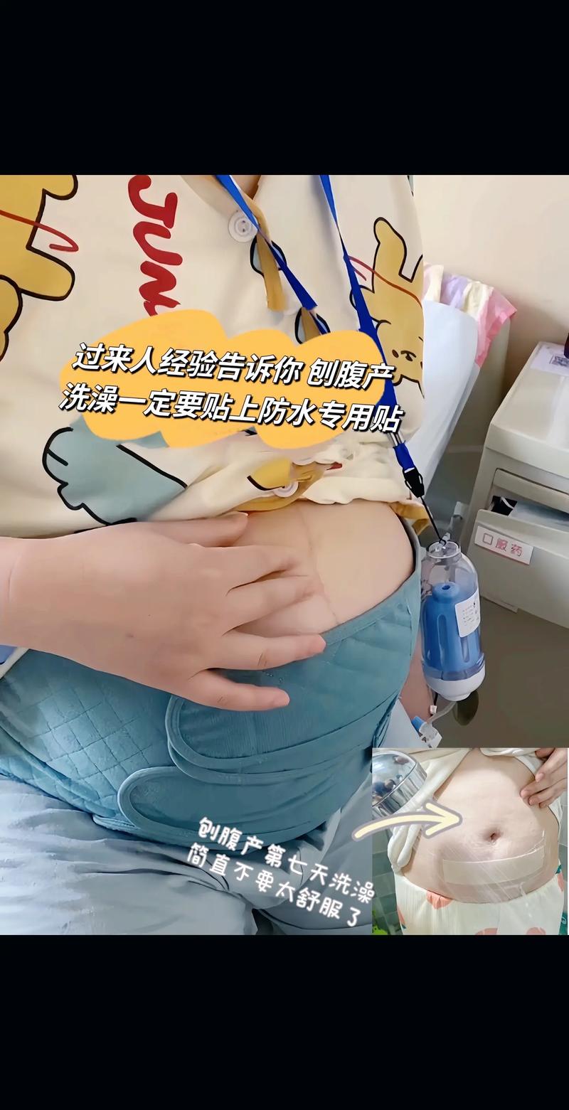 刨腹产多久可以洗澡(刨腹产多久可以洗澡刀口)