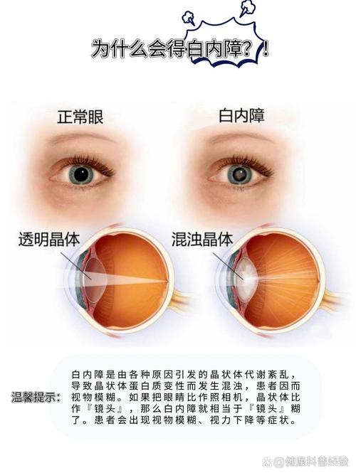 为什么会得白内障(为什么会得白内障这种病)