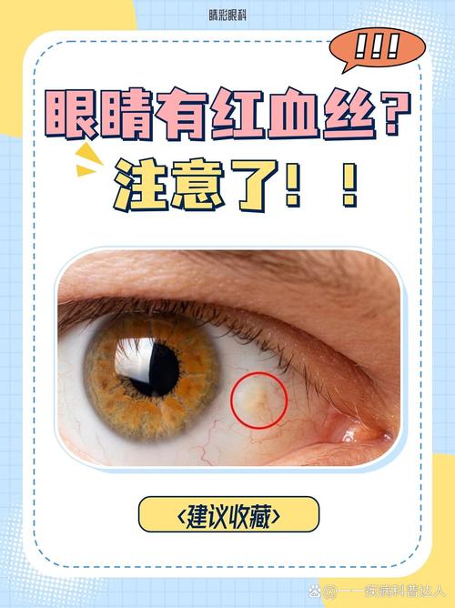 为什么眼睛有红血丝(为什么眼睛有红血丝的地方眼白还有点发黄)-第1张图片-天汇百科网 为什么眼睛有红血丝(为什么眼睛有红血丝的地方眼白还有点发黄)-第1张图片-天汇百科网