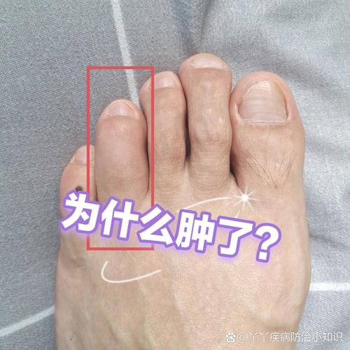 脚趾为什么会肿(脚趾为什么会肿起来不疼也不痒呢)