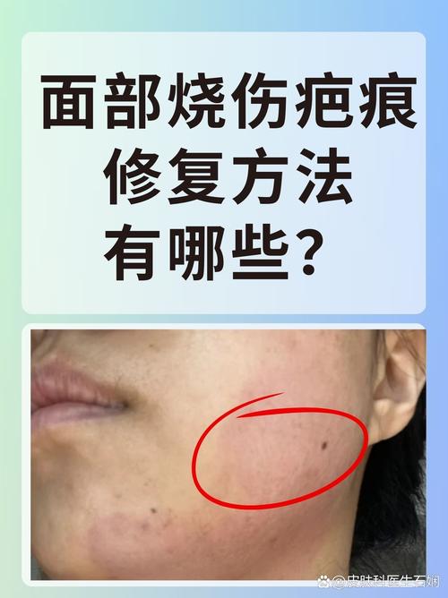 疤痕恢复期是多久(疤痕恢复期可以吃牛肉吗)-第1张图片-天汇百科网 疤痕恢复期是多久(疤痕恢复期可以吃牛肉吗)-第1张图片-天汇百科网