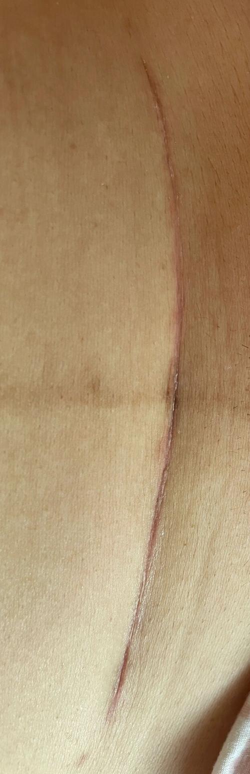 剖腹产多久伤口不痛(正常行走)
