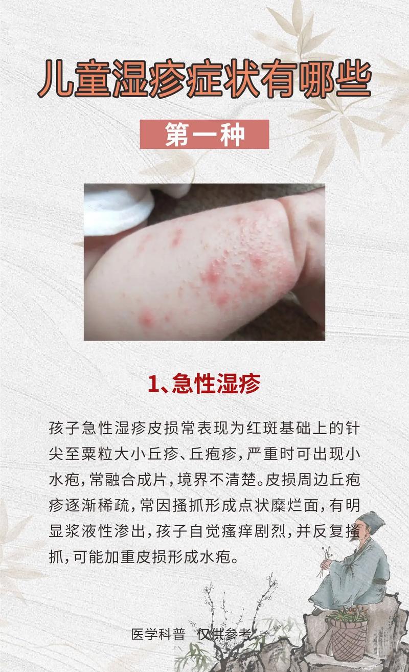 湿疹是因为什么原因引起的(疱疹湿疹是因为什么原因引起的)-第1张图片-天汇百科网 湿疹是因为什么原因引起的(疱疹湿疹是因为什么原因引起的)-第1张图片-天汇百科网