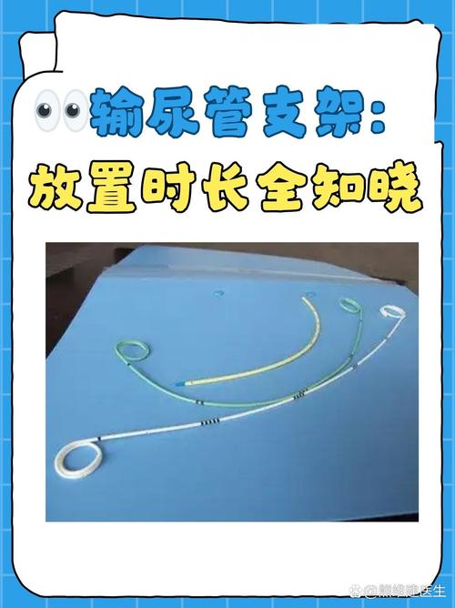 支架多久可以恢复(支架多长时间可以活动)-第1张图片-天汇百科网 支架多久可以恢复(支架多长时间可以活动)-第1张图片-天汇百科网