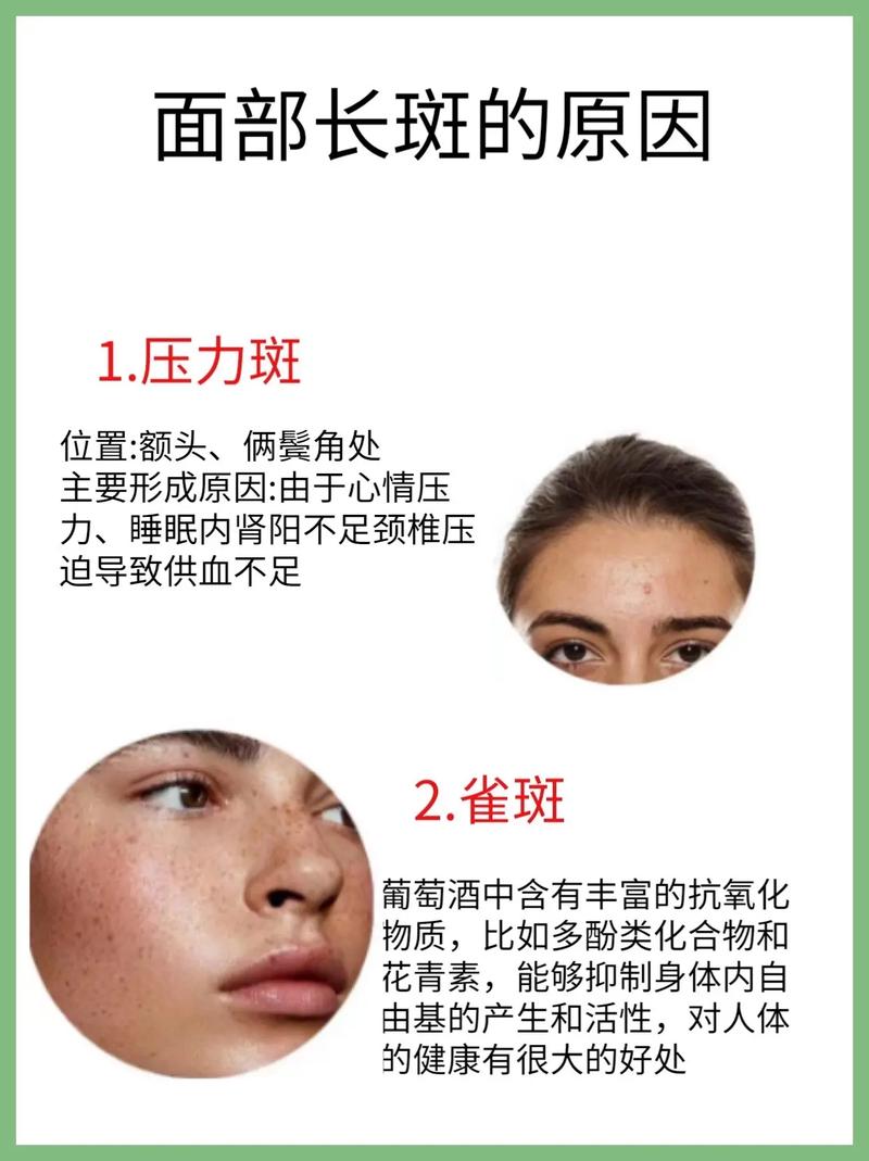为什么脸上容易长斑(为什么脸上容易长斑和痘)-第1张图片-天汇百科网 为什么脸上容易长斑(为什么脸上容易长斑和痘)-第1张图片-天汇百科网