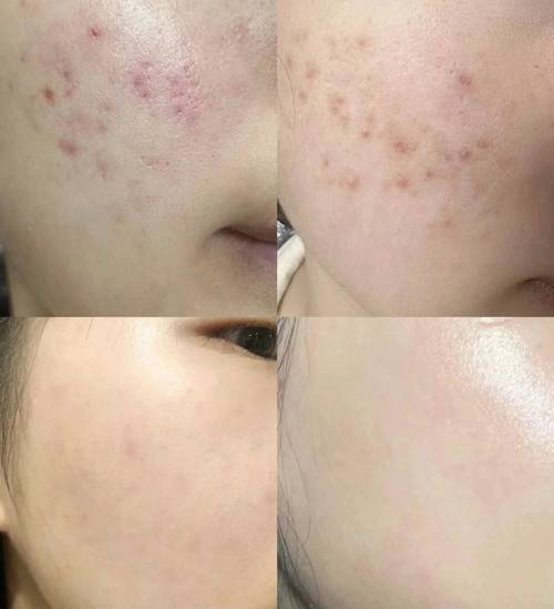 痘印多久能消除(痘印一般多久可以消掉)