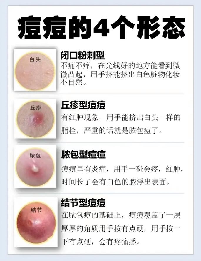 为什么容易长粉刺(为什么容易长粉刺呢)