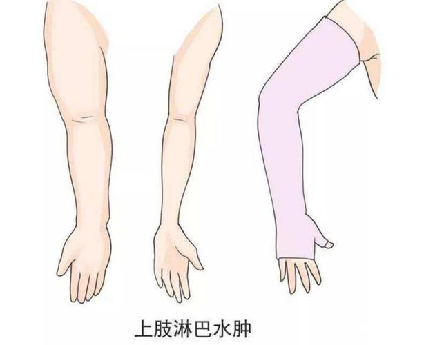水肿是怎么引起的(手臂水肿是怎么引起的)