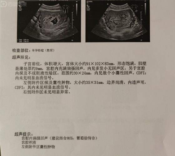 葡萄胎清宫后hcg多久能恢复正常(葡萄胎清宫后hcg多久能恢复正常)-第1张图片-天汇百科网 葡萄胎清宫后hcg多久能恢复正常(葡萄胎清宫后hcg多久能恢复正常)-第1张图片-天汇百科网
