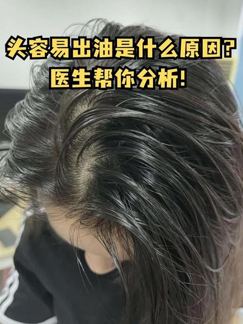 头为什么会出油(头为什么会出油怎么回事)