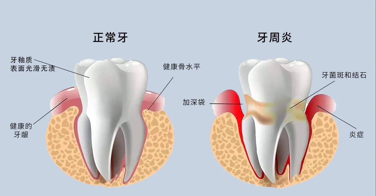 为什么会有牙周炎(为什么会有牙周炎能治好吗)