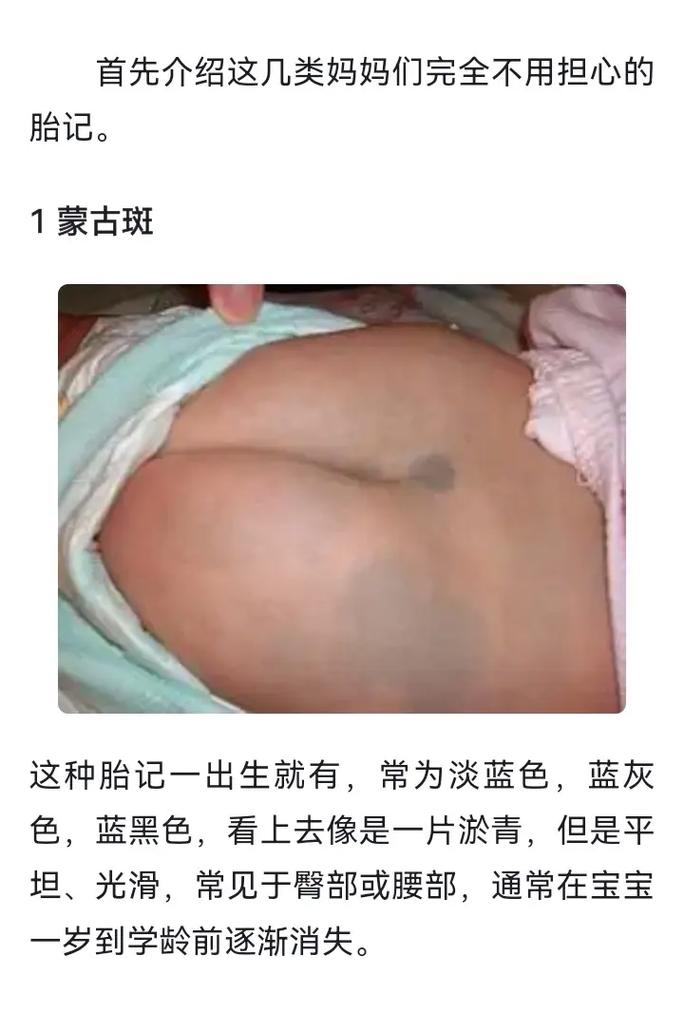 为什么胎记会长毛(为什么胎记的地方毛发多)