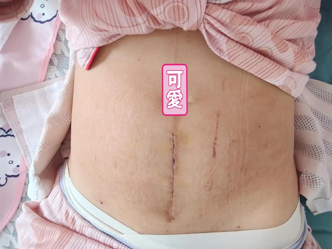 剖腹产多久伤口愈合(剖腹产多久可以同房最好)