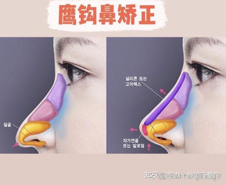 鹰钩鼻的人怎么样(鹰钩鼻的人性格)-第1张图片-天汇百科网 鹰钩鼻的人怎么样(鹰钩鼻的人性格)-第1张图片-天汇百科网